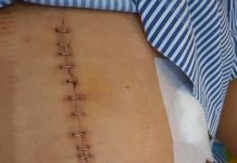 Cerita Korban Penikaman oleh Pendukung ADAMA, Usus Dipotong dan Disambung Lagi