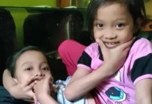 Penampakan Kembar Siam Asal Garut, Dinas Pendidikan: Keduanya di Jamin Hingga SMA