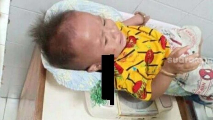 Busur menancap di pipi seorang bayi usia 1,7 tahun di Kota Makassar terkena busur korban perang antar kelompok, Selasa 1 Februari 2022 [SuaraSulsel.id/Istimewa]