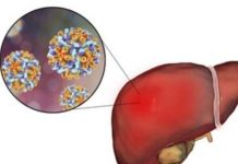 Masyarakat Diminta Waspada Dini Hepatitis Akut, Periksa Jika Kulit Kuning dan Urine Gelap FOTO: Ilustrasi Hepatitis (Istimewa)