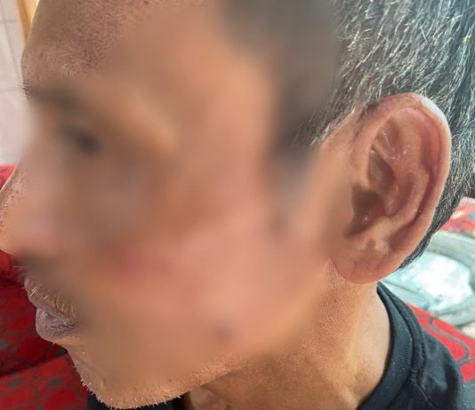 Hendak Melerai, Petugas Pajak Justru Dapat Bogem dari Oknum Anggota DPRD Bulukumba FOTO: Ancong (54) Petugas Pajak Bumi dan Bangunan (PBB) alami luka memar usai dianiaya.