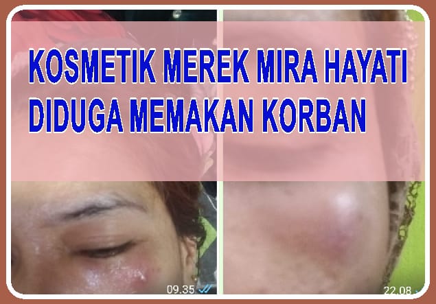 FOTO: Korban Kosmetik Mira Hayati