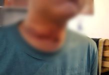 Putranya Alami Kecelakaan di Kawasan TSM, Andi Usman Minta Pertanggungjawaban Pengelola Parkir FOTO: Andi Raditiah Usman (17) warga Makassar mengalami kecelakaan di kawasan Trans Studio Mal (TSM).